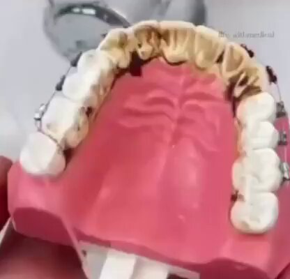 Bir su jeti sprey diş fırçası dişlerinizi nasıl temizler?
