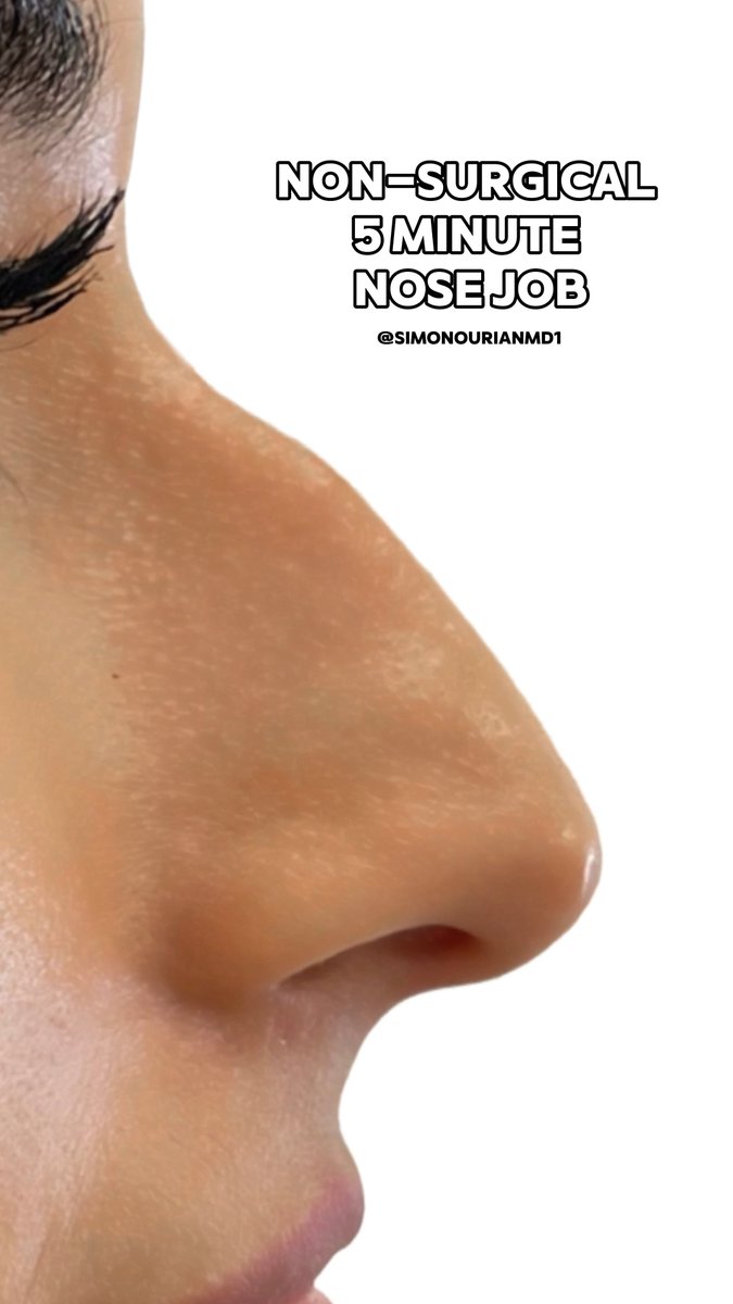 Non-surgical nose job reshapes the bridge, tip, and overall profile using precise Neustem™ placement—creating a smoother, more refined nose without surgery. Created to smooth bumps, balance symmetry, subtly lift a drooping tip, and refine definition—delivering natural-looking results with minimal downtime and no incisions. #NonSurgicalNoseJob #LiquidRhinoplasty #NoseFiller #ProfileEnhancement #NoseReshaping