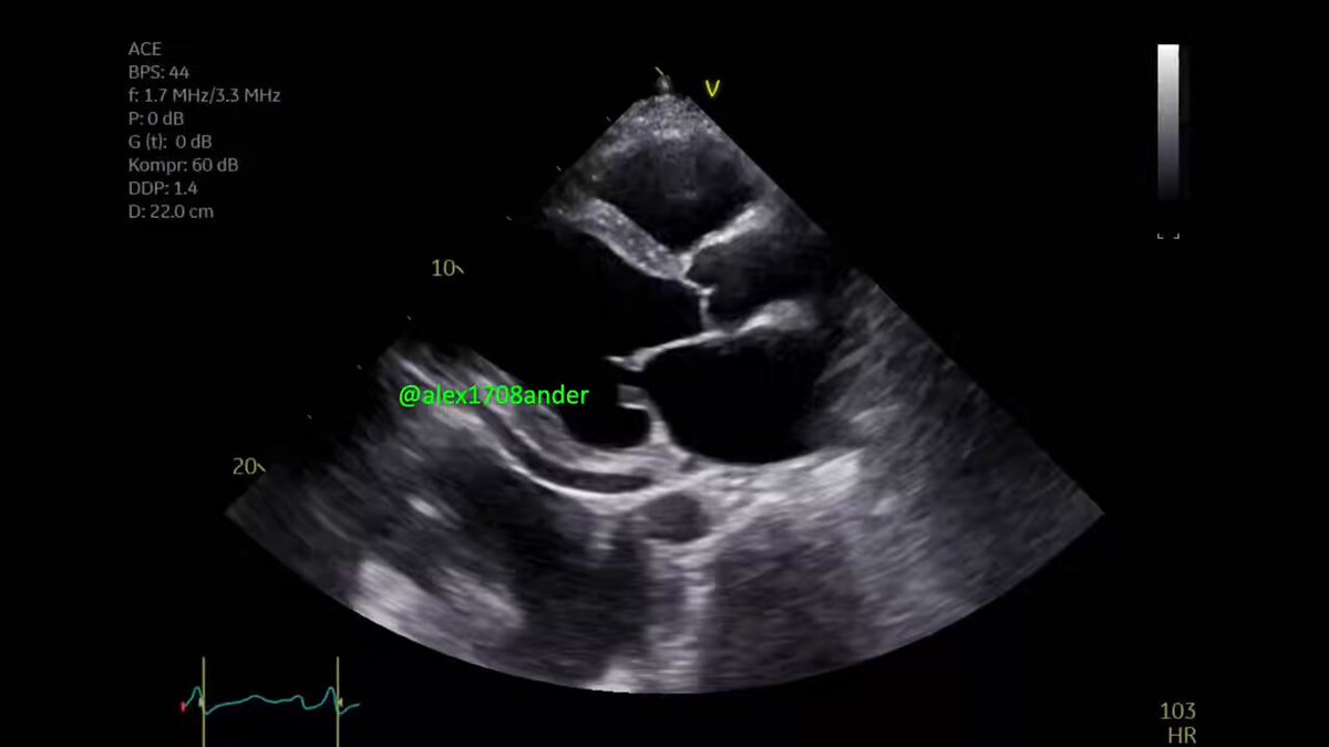 Intraop TTE for Impella 5.5 implantation in axillary approach #echofirst Conscious patient (light sedation) with NSTEMI (ischemic cardiomyopathy) No tube, no TEE, no fluoroscopy! Just TTE … and #volumetrics