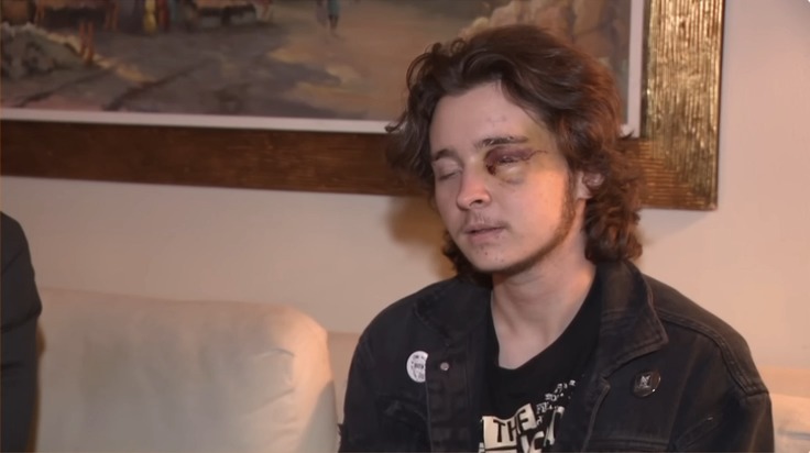 21-year-old activist injured by ICE: I will be blind for life. I have fractures in my skull that they can't fix. I can't sneeze or cough because it's dangerous to. They pulled a piece of plastic the size of a nickel out of my eye. I had shards of metal, glass, and plastic behind my eye and in my skull. They said it was a miracle I survived.