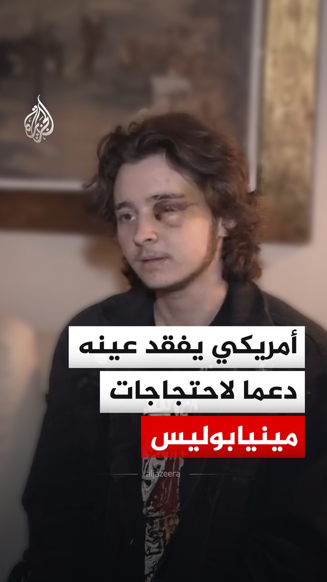 شاب أمريكي يفقد عينه اليسرى خلال مظاهرة مناهضة لوكالة الهجرة والجمارك، أمام مبنى اتحادي في سانتا آنا بولاية كاليفورنيا الأمريكية، احتجاجا على مقتل السيدة رينيه نيكول غود على يد أحد أفراد الهجرة والجمارك في مينيابوليس #فيديو