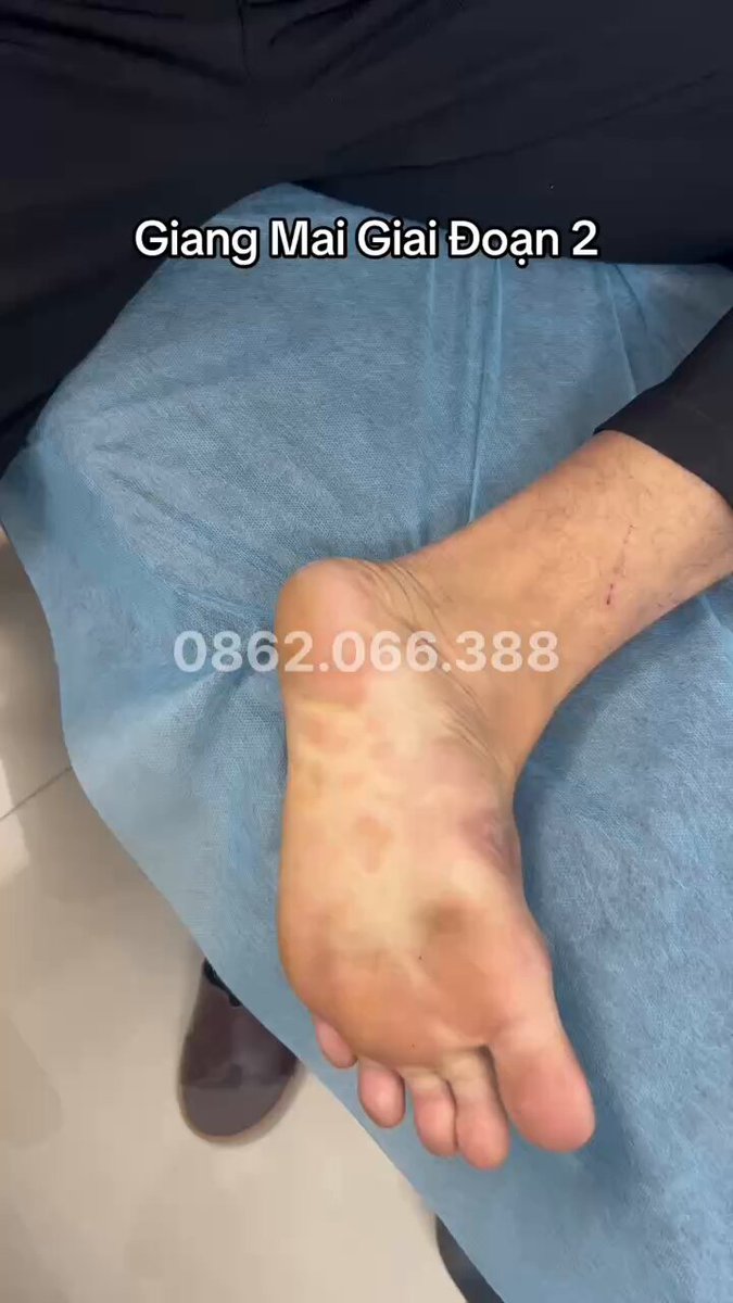 Lại tiếp Giang Mai giai đoạn 2 của em Trai Thẳng. 3 tháng trước có QH không an toàn vs bèo. Mọi người lưu ý ban giang mai nổi ẩn dưới da, không ngứa, chủ yếu phát trên bụng , lòng bàn tay và bàn chân… Cả nhà nhớ QH An Toàn giúp Quyền nhé, mỗi lần QH nhớ cái mặt tui là phải an toàn, dị đi…