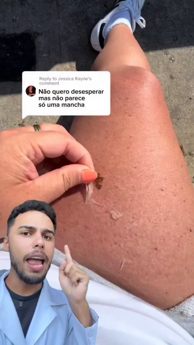 muita atenção às manchinhas na sua pele, porque podem ser câncer! ele explicou direitinho como identificar