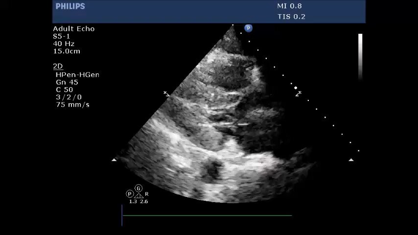 What's wrong? context: hypotension, tachycardia #POCUS #echofirst #Nephpearls (see thread for 🔗to answer/case)