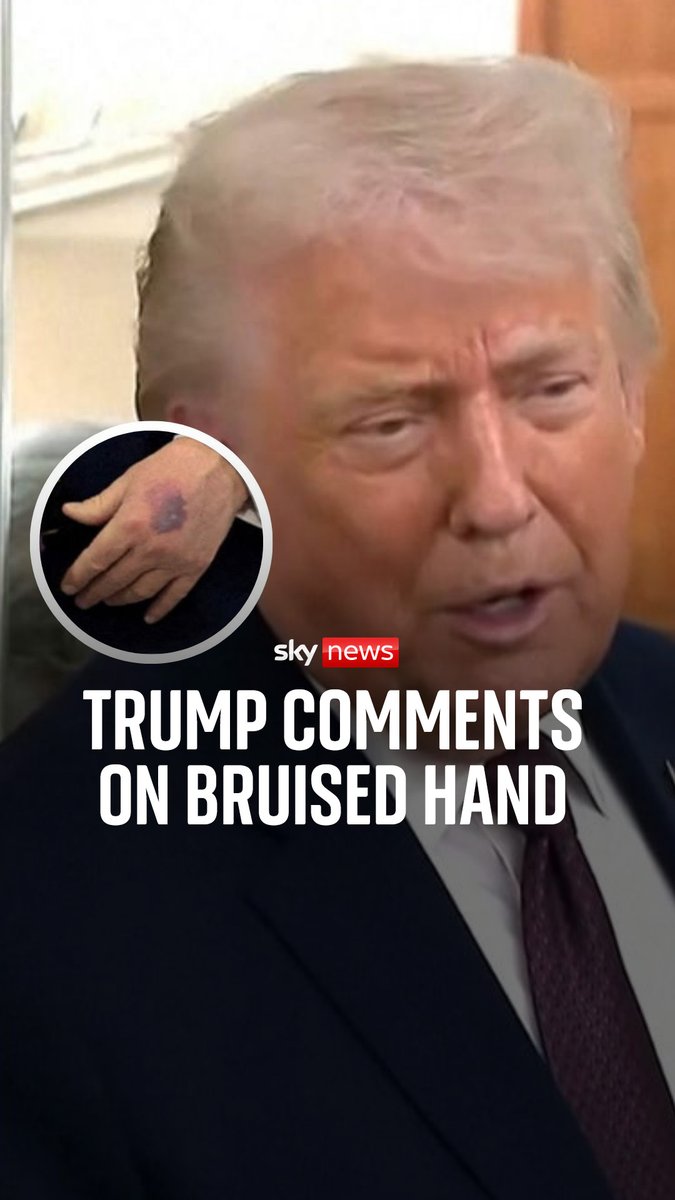 Donald Trump was asked about why he has bruising on his hand while on Air Force 1. He said the bruising happened because he "clipped it".