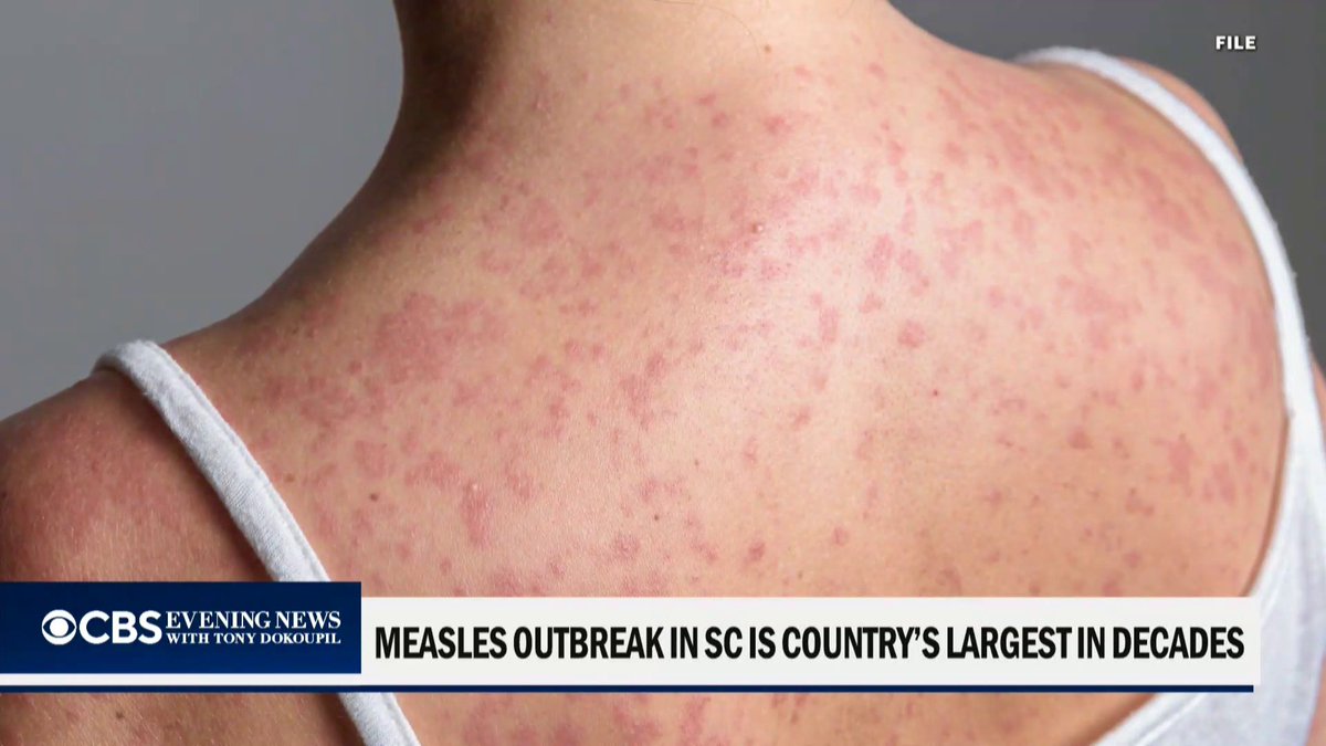 The measles outbreak in South Carolina has become the largest the U.S. has seen since the disease was declared eliminated 26 years ago. Nearly 800 cases have been confirmed and a large majority of them are among the unvaccinated. CBS News’ Jonathan LaPook, M.D has more.