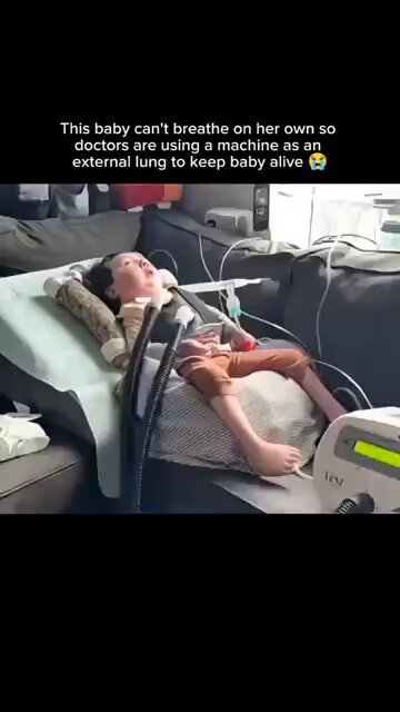 This baby is receiving life support because she can’t breathe on her own yet. Doctors are doing everything possible to keep her stable. 🤍