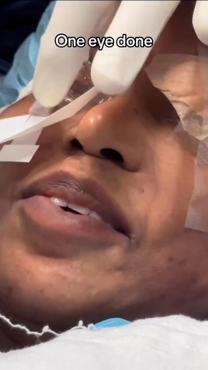 Eye color change procedure based on 15 years of keratopigmentation