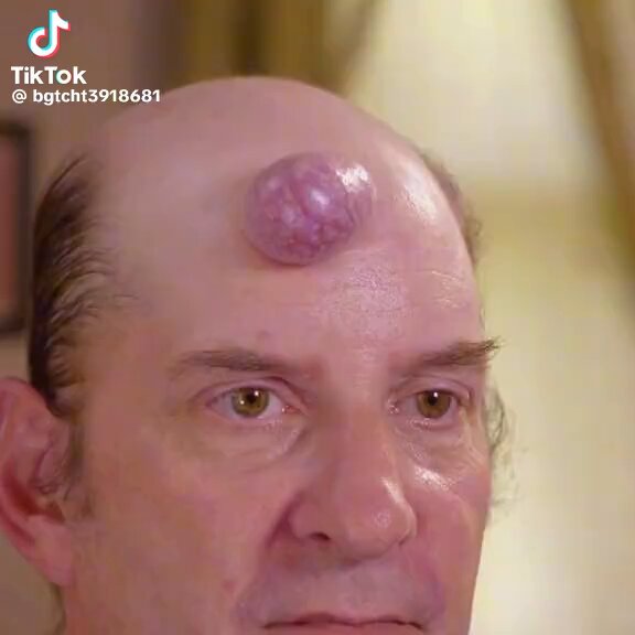 The lump on Todd’s head is ruining his life but he hasn’t seen a doctor about it in 25 years. 🤔