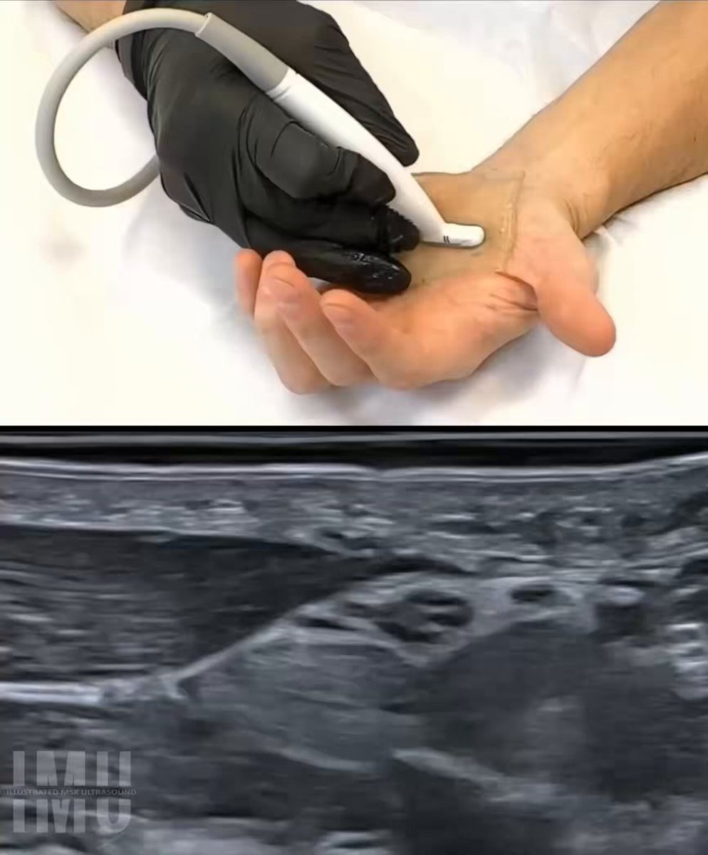 🖐️ Recurrent motor branch of the median nerve It arises from the median nerve at or distal to the carpal tunnel, with a highly variable origin: it may be extraligamentous, subligamentous, or transligamentous (passing through the flexor retinaculum). In the palm, the branch courses toward the thenar eminence and becomes superficial as it curves around the superficial head of the flexor pollicis brevis. On ultrasound, its origin can usually be identified approximately at the level where the proper palmar digital nerves to the thumb arise: once these digital branches are recognized, a third branch may be seen coursing proximally and radially, becoming superficial and skirting the superficial head of the flexor pollicis brevis. This corresponds to the recurrent motor branch. At this level, it follows a very superficial course, making it particularly vulnerable to traumatic or iatrogenic injury, especially during carpal tunnel release. ⚠️ It is essential to recognize its anatomy and variants, as they are common. The transligamentous variant, in which the branch passes through the flexor retinaculum, carries the highest surgical risk. 🎯 Function: innervates the thenar muscles responsible for thumb opposition. #mskrad