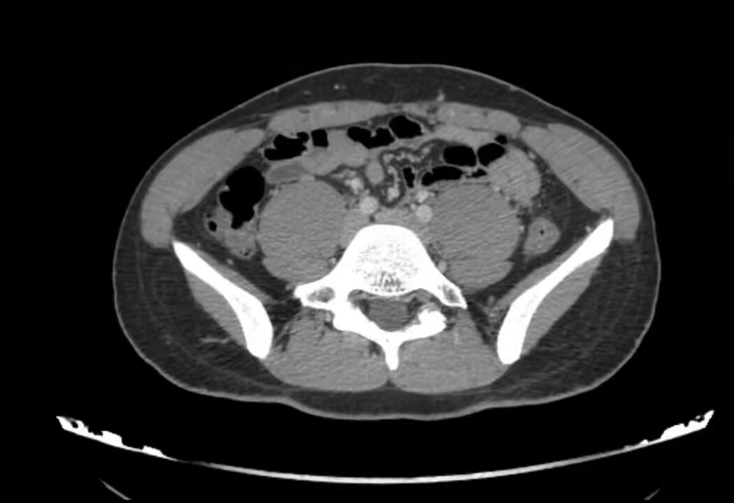 جي اس او طوارئ وودك تتعلم كيف تشوف appendicitis عشان حضرة الراديولجست القدير مشغول بالbrain CTs هذا المقطع شرحت فيه الuncomplicated appendicitis اي واحد يكلمني ويقول ما فيه fat stranding مب اطيب له ترا