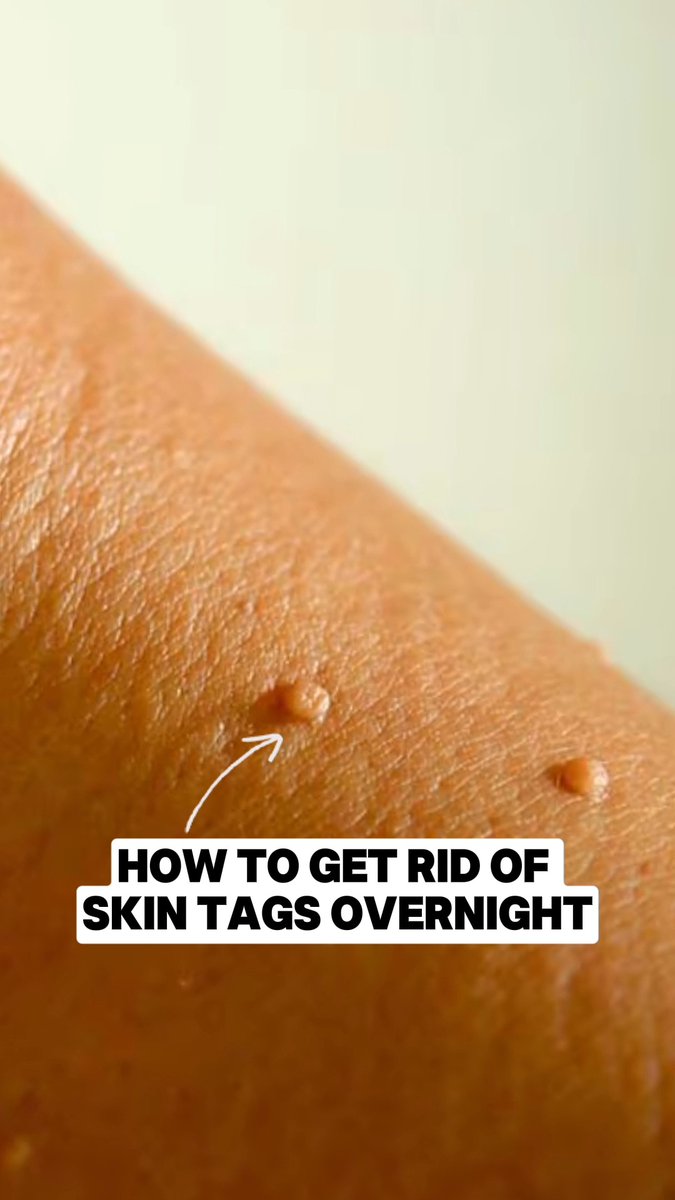 This is how to get rid of skin tags FAST!