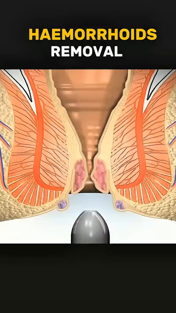 Haemorrhoids removal