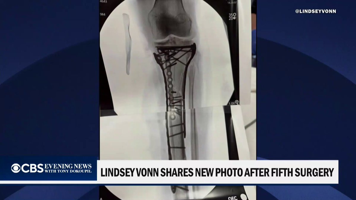 Lindsey Vonn has had five surgeries to repair her leg after she snapped her tibia during her run for gold in the Winter Olympics earlier this month. The ski star says she’s been “struggling a bit post-op” and praised her surgeon.
