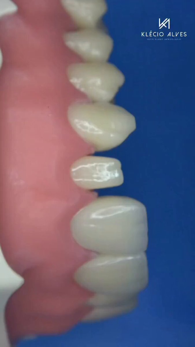 very neat dental veneers🦷😁