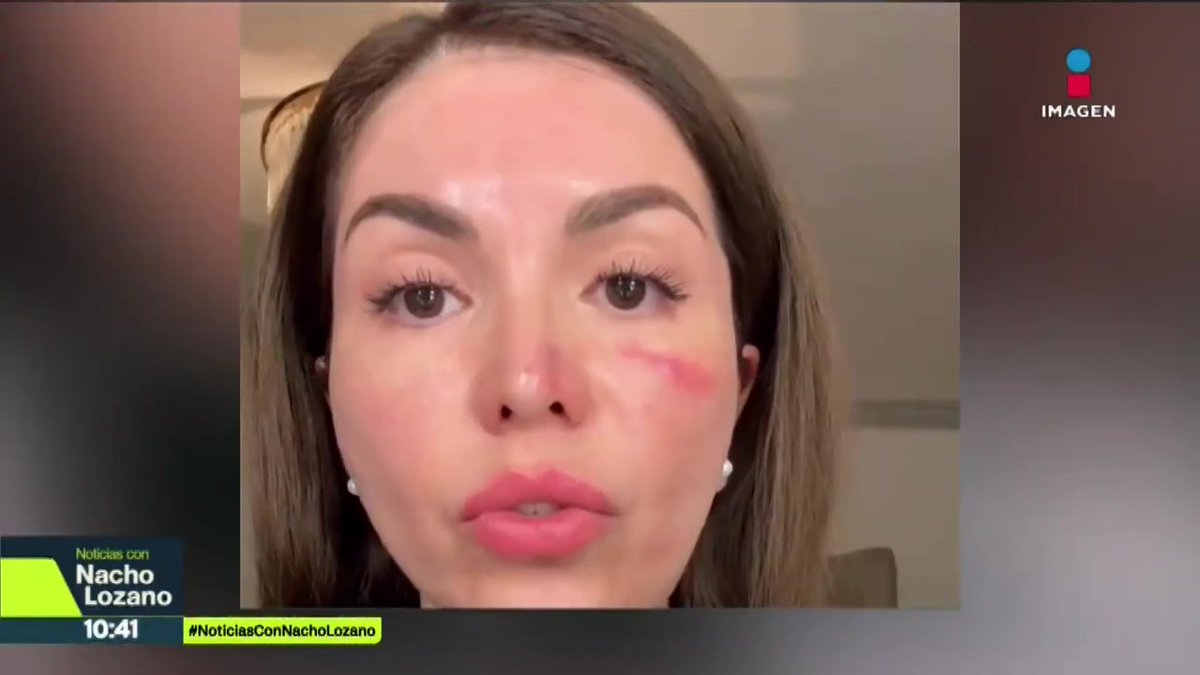 “Me amarraron, me golpearon y me tocaron mis partes íntimas”, así narró Evelyn Villa, influencer y nutricionista, que fue atacada a plena luz del día por al menos cuatro hombres en su casa en #Toluca, en el #Edomex. Nacho Lozano #NoticiasConNachoLozano #NoticiasImagen