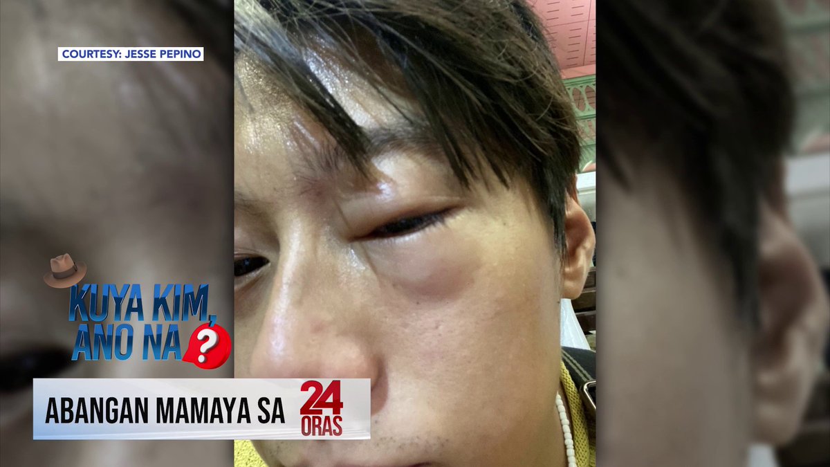 LUMALA IMBES NA GUMALING? Halos 'di makilala ang isang lalaki dahil sa pamumula at pamamaga ng kaniyang mata! 'Yan ay matapos niyang uminom ng painkiller para sa sakit ng ulo. Ang paliwanag ng doktor sa kaniya, alamin mamaya sa #KuyaKimAnoNa sa 24 Oras!