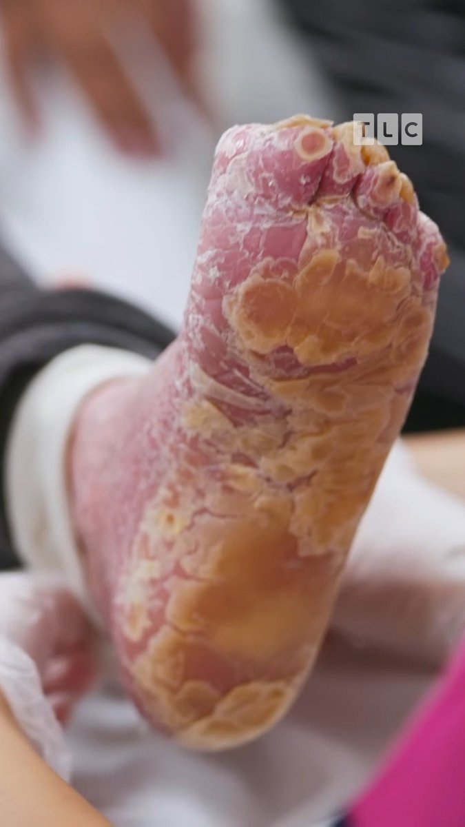 Let's get those nippers ready! The docs are on the case at #TheBadFootClinic, Wednesdays 10P on TLC.