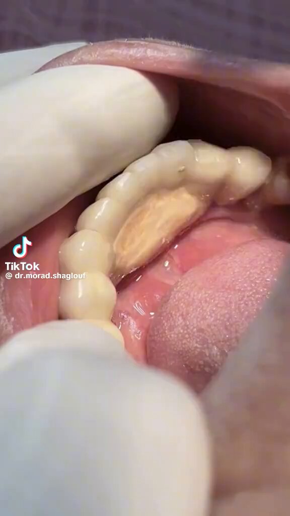 Scaling of tartar &amp; calculus from teeth