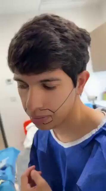 Un hombre que se sometió a un trasplante de barba porque no podía dejársela crecer se ha convertido en uno de los temas más comentados en las redes sociales debido a su inusual aspecto tras la operación.