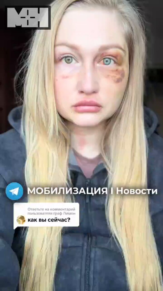Ветеран без ноги, но с ПТСР выучился после возвращения с войны на психолога и избил жену Москвичка Александра Назарова опубликовала фото со следами избиения и рассказала, что это дело рук её супруга, страдающего после возвращения с фронта неконтролируемыми приступами агрессии, особенно в состоянии опьянения. По словам женщины, муж избил её после просьбы починить дверную ручку, которую он сломал в предыдущем порыве ярости. Владислав Назаров подписал контракт в октябре 2023 года и служил старшим стрелком-санитаром в подразделении «Шторм V». После тяжёлых ранений ему сделали десятки операций и ампутировали ногу. Вернувшись с войны, Назаров получил высшее образование по специальности психолога-консультанта и прошёл обучение на токаря. Супруга всегда поддерживала его и навещала в госпитале, но после избиения не выдержала и подала на развод. Тут мы видим классическую историю, как государство пытается социализировать ветеранов для галочки, закрывая глаза на «слона в комнате» — огромную проблему с психологической реабилитацией. И вроде получил человек образование, но самому себе этот новоиспечённый психолог помочь оказался не в состоянии, из-за чего пострадала супруга и разрушилась семья.