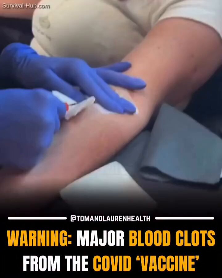 Five years on and doctors are still extracting huge fibrous Blood Clots from the Covid Vaccinated. If you took the jab you should still absolutely go and take a blood viscosity test.