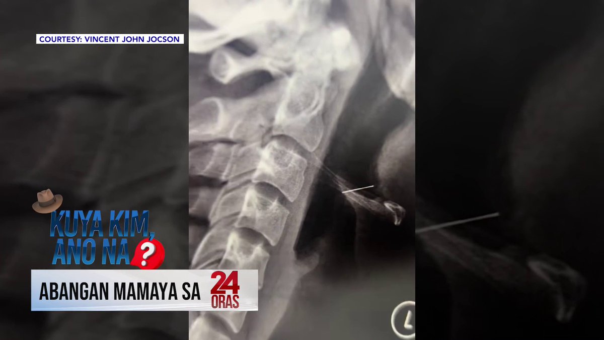 BABALA: Sensitibo ang laman ng video. Maging maingat at responsable sa panonood at pagkomento. HALA, NALUNOK! 😱 Naalarma ang isang lalaki mula Pampanga nang malunok at bumara pa sa kanyang lalamunan ang wire ng kanyang braces! Paano kaya matatanggal? Kuya Kim, ano na? Mamaya 'yan sa 24 Oras!