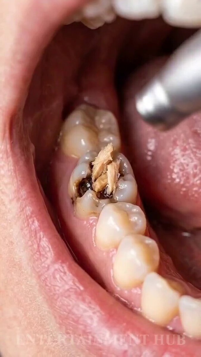 Diş sağlığı önemlidir. Güzel gülüşler için sağlıklı dişler gerekir.👇♏️