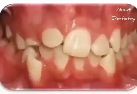 Orthodontic treatment timelapse