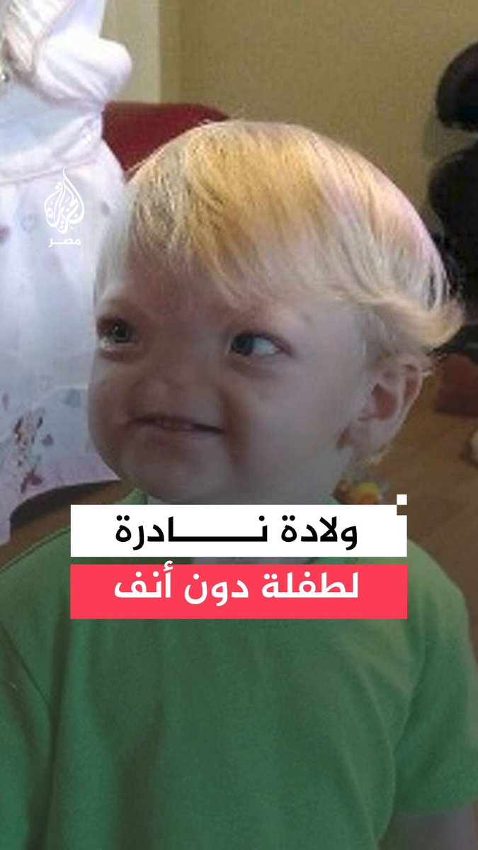 صانع محتوى يستغيث بالأطباء لإيجاد حل لحالة طفلته النادرة التي ولدت بها دون أنف بعد رحلة طويلة بين الأخصائيين لإيجاد سبيل طبي لابنته