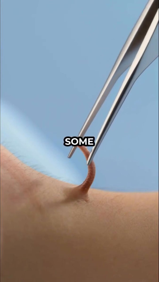 Why You Should Never Use Tweezers on Skin Tags?😳