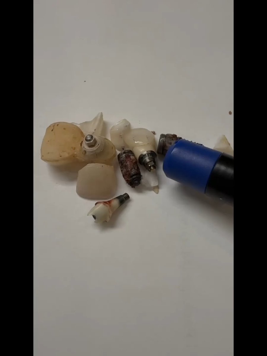 If 4yrs of being a biohacking guinea pig led me to this day. I’d do it 10X over. After 15yrs of being told I needed rotator cuff surgery, the pain is gone through this unexpected procedure. No surgery. @drjgandhi changed everything: He never promised to fix my shoulder. He simply showed me what was happening in my body by examining my teeth. What he removed from my jaw—metal, toxins, hidden issues—was shocking. The result was immediate. That’s not a claim. That’s a FACT from me and me alone. Before the procedure, I did acoustic therapy at @protocal4. After the procedure I did the same exact therapy w 3X the pressure. I’ll let the video speak for itself. Then the additional data came back from the lab on what he pulled out of me. And I was shocked I found out that I have a strain of Lyme disease in my jaw. I’ve been tested for Lyme 5X and it was never found. Also a rare parasite and heavy bacterial load, all found in my jaw. Now I can target exactly what’s in my system to kill. Before this, I would’ve been treating symptoms while the root cause remained. This wasn’t just a procedure, it was a wake-up call. We need more professionals willing to challenge outdated thinking and look at the body as a connected system. If you’re not getting answers, start asking different questions. You have to be your own advocate. Thank you Gary Brecka - Videos, Tips & Lectures (Fan Page) and @sagebrexka for turning Heather John and I on to Dr Gandhi. And thank you Dr Gandhi and all the biological dentist for having the open mind to challenge the way dentistry has been done forever. Take care of yourself. - The Longevity Shark