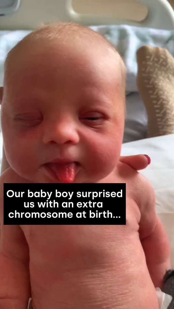 One extra chromosome, a whole lot of joy! 💖✨