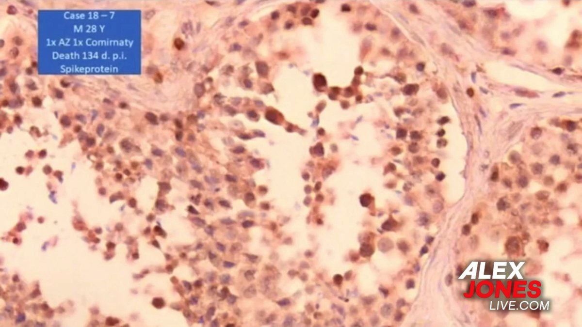 VIDEO: Top Doctor / Scientist Confirms The mRNA COVID Injection Takes Over Men's Testicles & Turns Them Into Factories Of Spike Proteins That Can Shed, Infect, & Sterilize Any Woman They Have Sex With! Bottom Line— The So-Called COVID Vaccine Is A Sterilization / Depopulation Weapon! 🔴WATCH/SHARE THE LIVE X STREAM NOW: