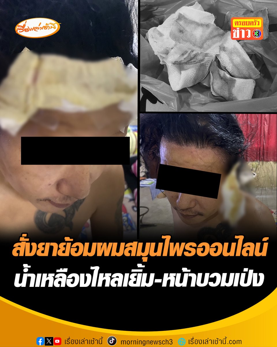 อุทาหรณ์! สั่งยาย้อมผมสมุนไพรจากออนไลน์ แพ้หนักถึงขั้นหัวเน่า ทำน้ำเหลืองไหลเยิ้ม-หน้าบวมเป่ง พบสินค้ายี่ห้อนี้ไม่มีเลขจดแจ้ง อย. เตือนตรวจสอบหรือดูรีวิวให้ดีก่อน เพราะบางยี่ห้อโฆษณาเกินจริง #เรื่องเล่าเช้านี้ #ครอบครัวข่าว3 #ข่าวภูมิภาค #ราชบุรี #ยาย้อมผมสมุนไพร #สั่งซื้อออนไลน์