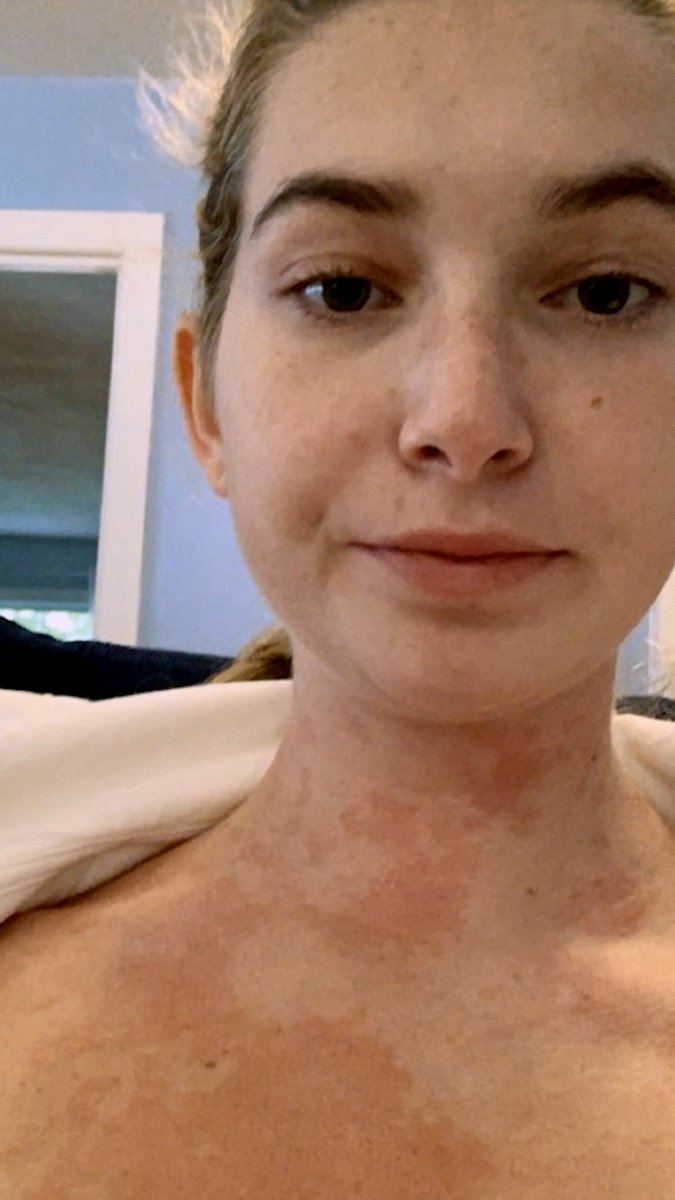 Caroline has a rare condition called mast cell activation syndrome. Diagnosed following a severe allergic reaction, her incredible medical journey includes daily navigation of safe foods, work, and living environments. Follow her amazing story in #OneDayInMyBody tonight 9P on TLC.