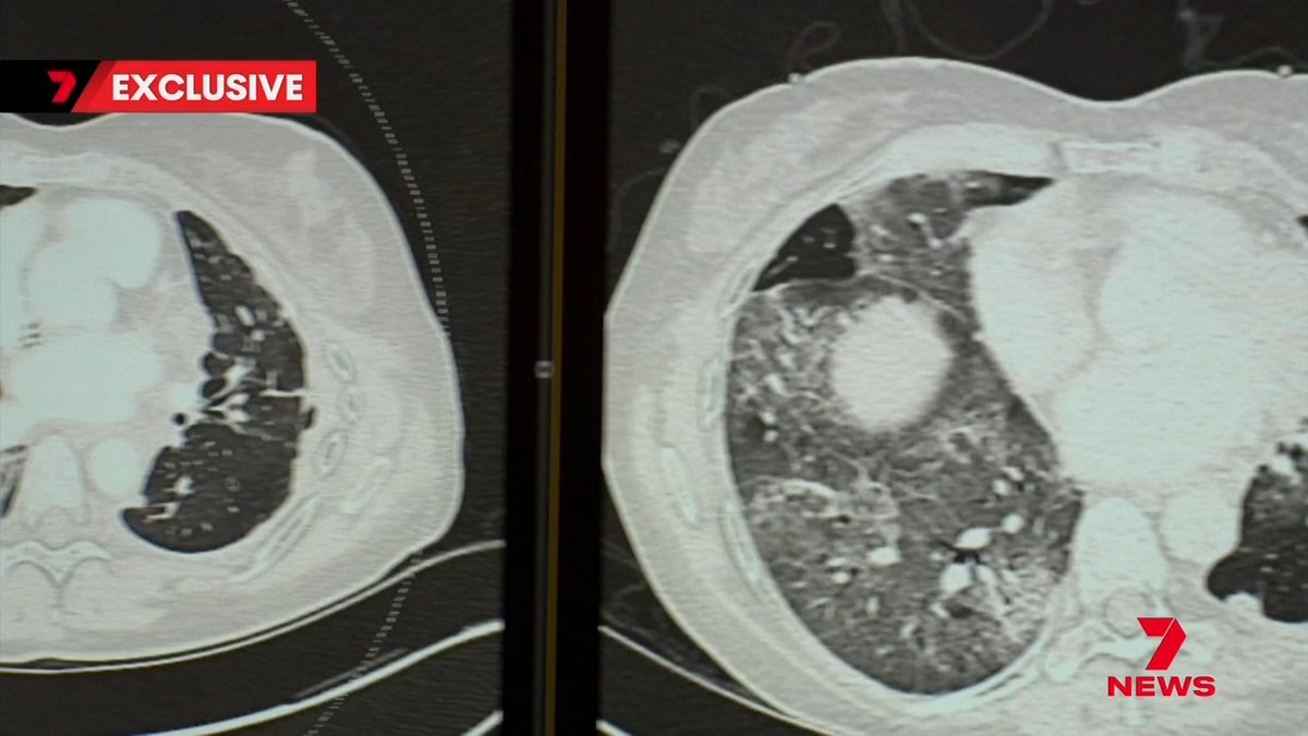 Early onset bowel cancer in young Australians is surging, with cases rising 4% annually and now representing the deadliest cancer for people aged 25 to 54.