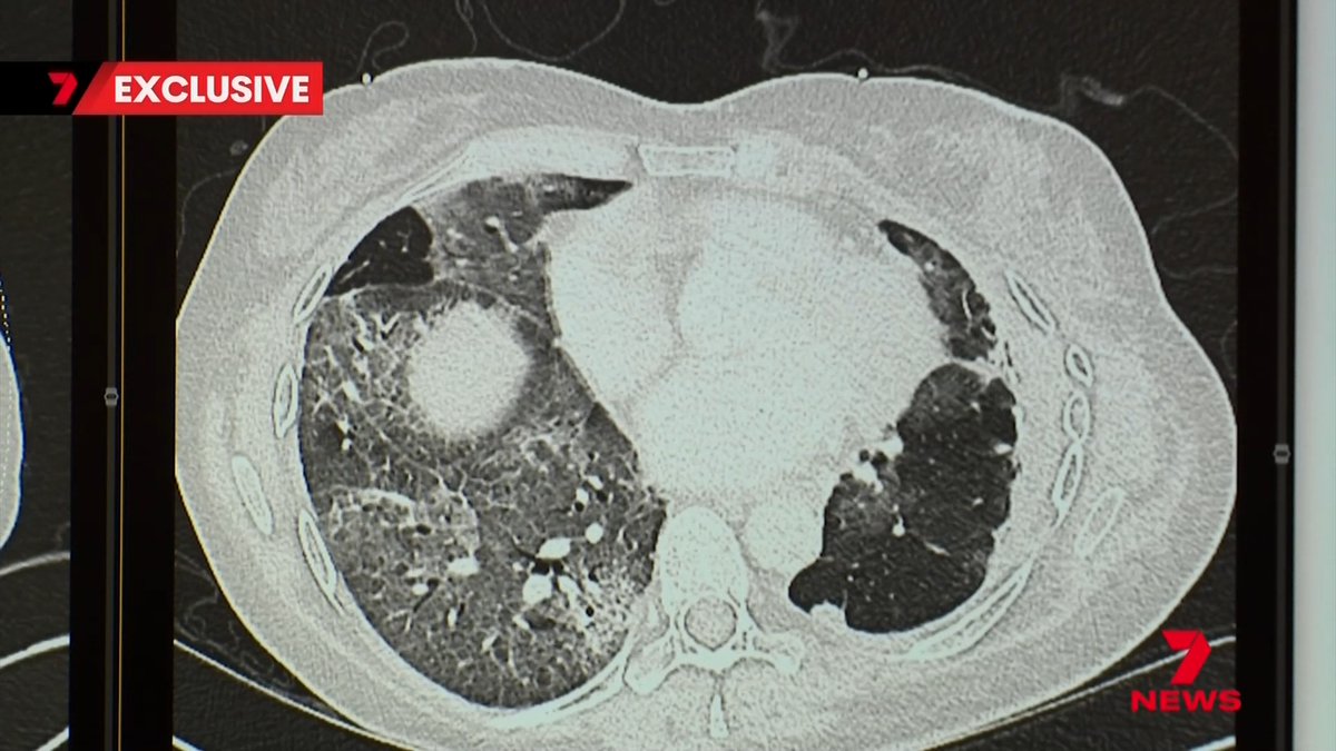 Doctors are warning early onset bowel cancer should now be treated as an entirely new disease, with cases in young Australians surging. Experts say the cancer is behaving differently to traditional bowel cancer.