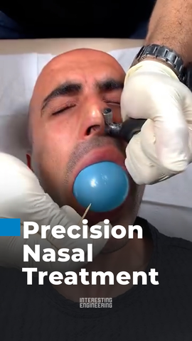 🇺🇸A sinus balloon procedure uses a tiny balloon inside the nose to open blocked airways and help people breathe better. A balloon a day keeps the doctor away.