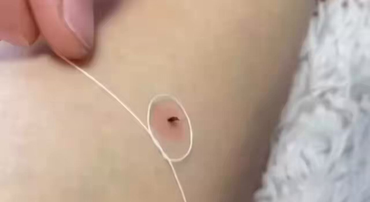 ليش الأطباء ما قالوا لنا عن هالطريقة من زمان لا ليزر ولا فلوس!