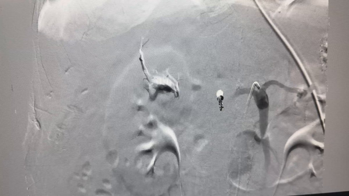 Tough one on call - tried to avoid intervention and hope for steroids to help improve inflammation but patient crashed… selective embolization performed to try and maintain hepatic arterial supply - although with patent PV would it matter? What would you do?