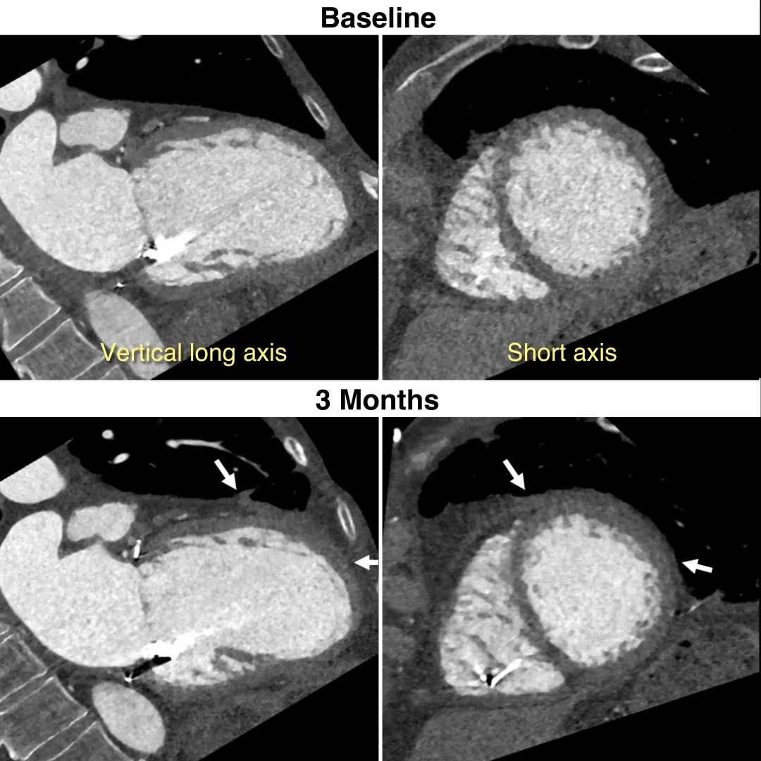 A video shows cardiac computed tomography in a patient with heart failure treated with stem-cell–derived biologic ventricular assist tissue. Read the full BioVAT-HF study results to learn more: