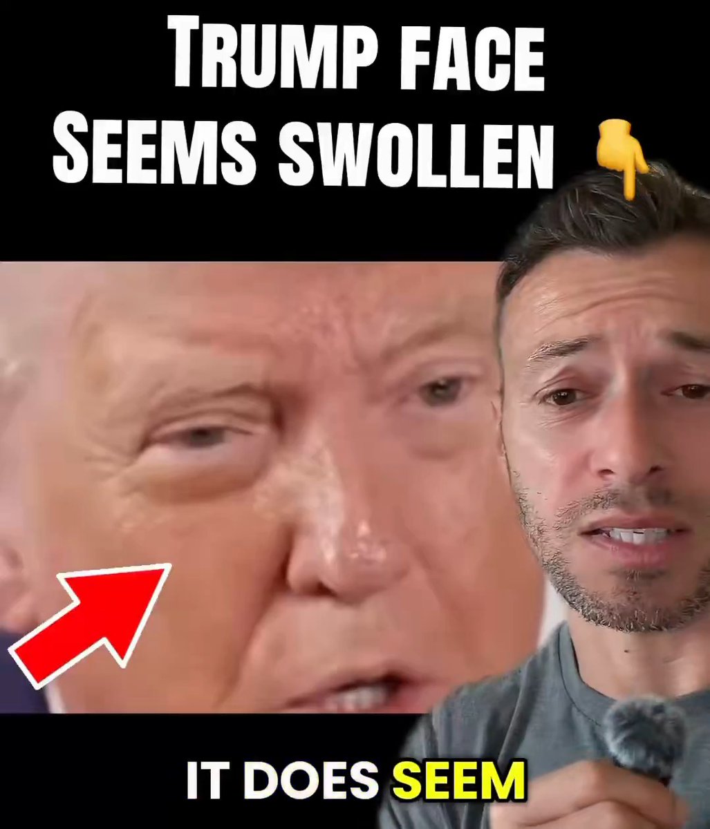 BREAKING: Trump has not been seen at a public event in nearly a week. Here’s one of the few clips of him since then, and his face appears to be swollen.