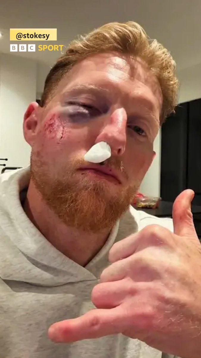 ”It could have been way, way worse!” Ben Stokes speaks about his facial injury and the following surgery after he was hit by a ball while coaching in February.