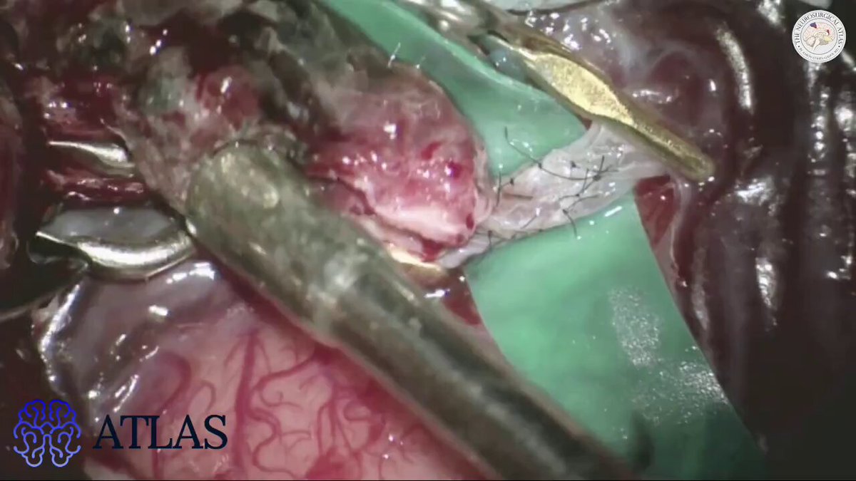In this operative video, Dr. Cohen demonstrates the frontotemporal approach for STA-MCA bypass and proximal M2 occlusion of a giant MCA aneurysm. After the bypass anastomosis is completed, the temporary clips are removed and mild bleeding from the site confirms graft patency. Cotton is used to reinforce the anastomotic site, and Doppler ultrasonography verifies flow through the donor vessel. A temporary clip is then placed proximal to the aneurysm, with intraoperative angiography confirming minimal aneurysm filling and preserved bypass flow before permanent clip placement is performed. Learn more here: #Neurosurgery #MCAAneruysm #DrCohen #SurgicalExcellence