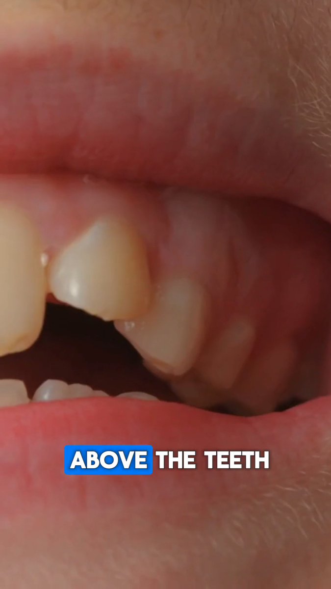 This is how to STOP receding gums! Share this with someone it could help. Dr. Eric Berg, DC, not MD; information only