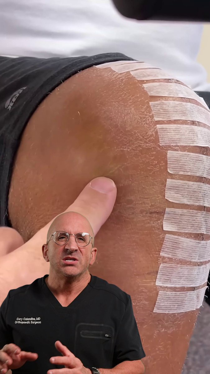 The quiet knee protocol is changing how we approach knee replacement recovery. Instead of aggressive early bending, it calms swelling and inflammation first. Recent data on 15,000+ patients: less opioid use, shorter hospital stays, same long-term outcomes. #kneereplacement