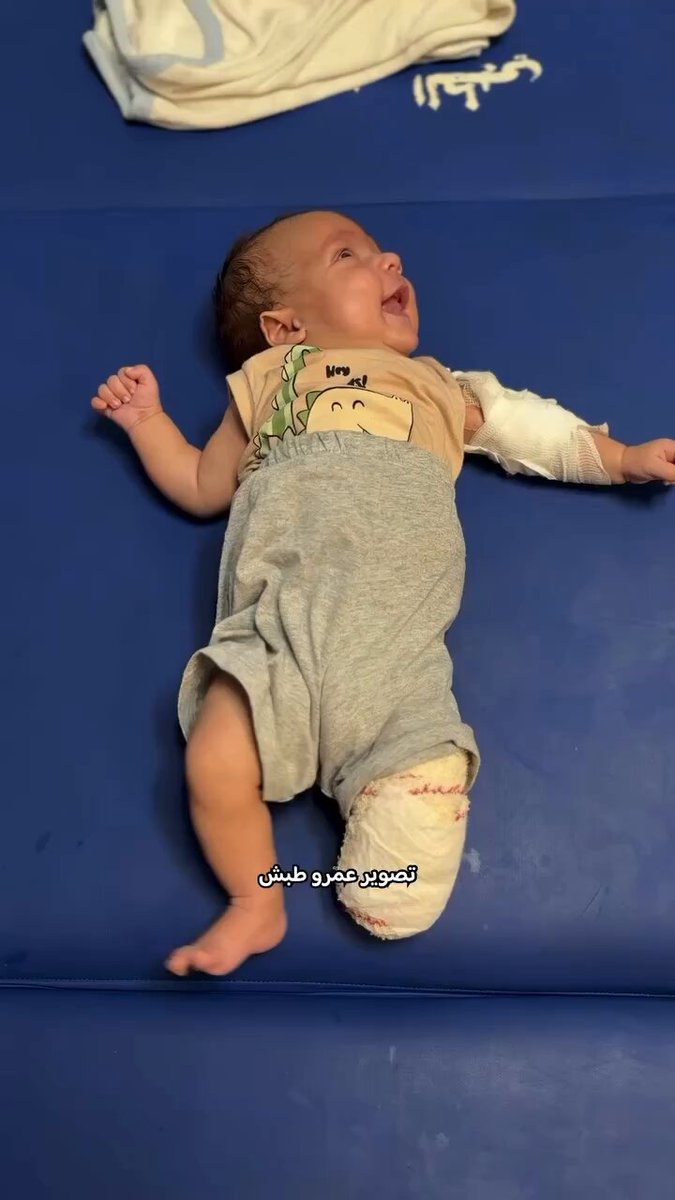 🚨 Update: Three month old babay Mohammed Al-Khatib remains at risk of losing more of his limbs after an Israeli strike killed his mother while she was breastfeeding him in a tent for displaced families in Gaza. His leg has already been amputated, and doctors now warn that his injured hand may also need amputation. Time is running out. Mohammed urgently needs medical evacuation and specialized treatment abroad before it is too late.