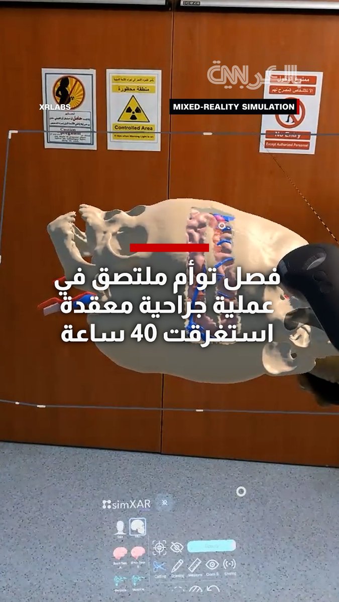 بمساعدة الذكاء الاصطناعي.. فصل توأم ملتصق في عملية جراحية معقدة استغرقت 40 ساعة