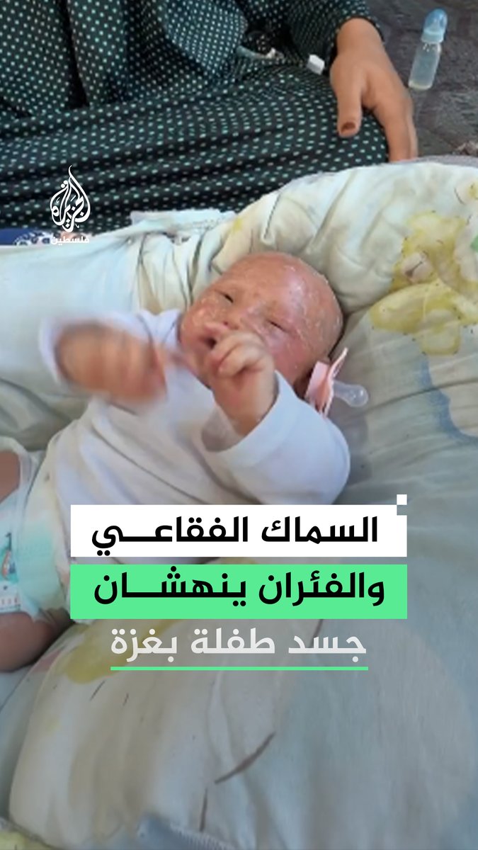 مرض جلدي وفئران تهاجم خيمتها.. الرضيعة أيسل الهمص "3 أشهر" تواجه الموت وتنتظر إنقاذها في غزة #فيديو